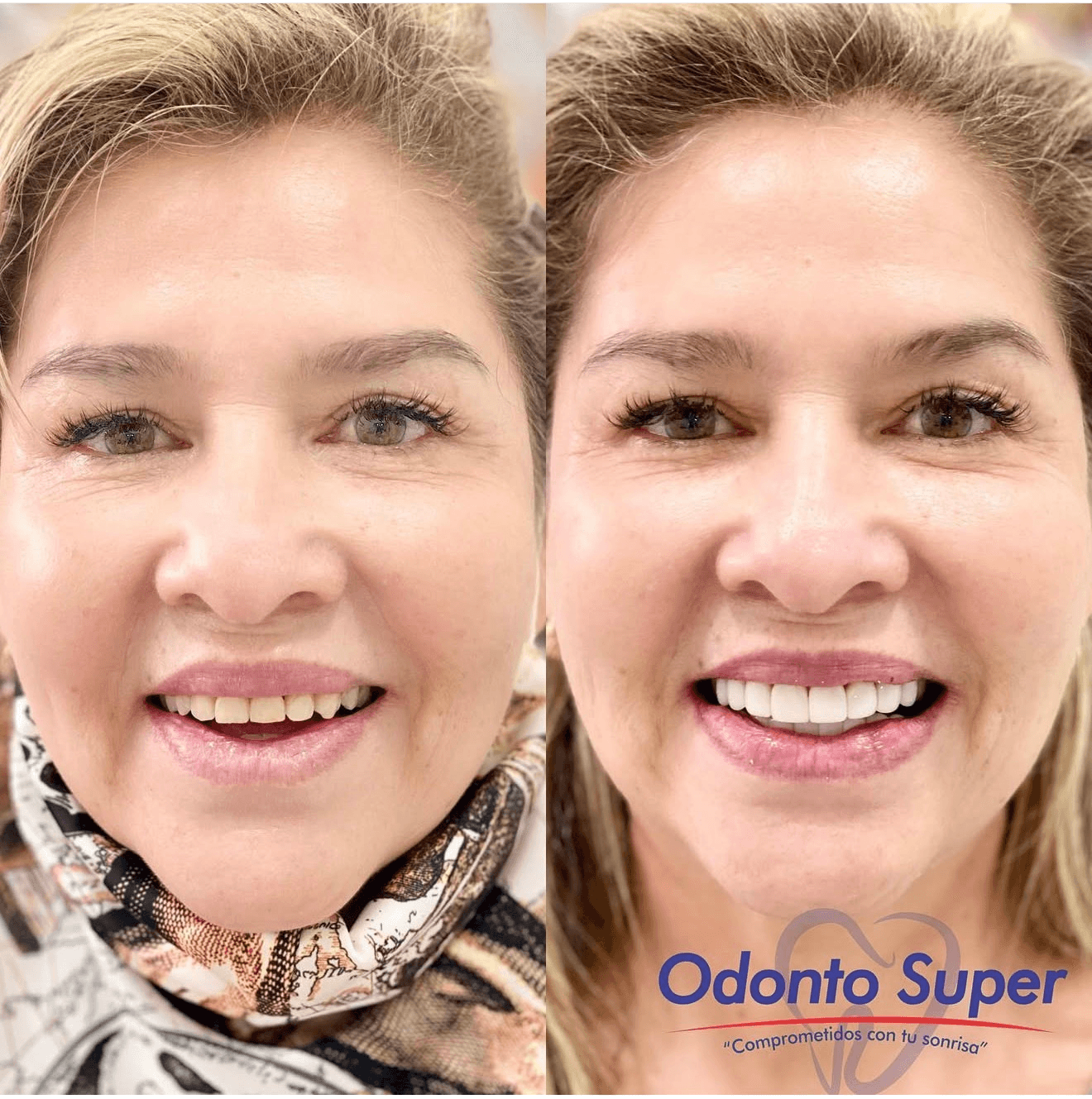 A real patient before and after with a flawless, naturally white smile