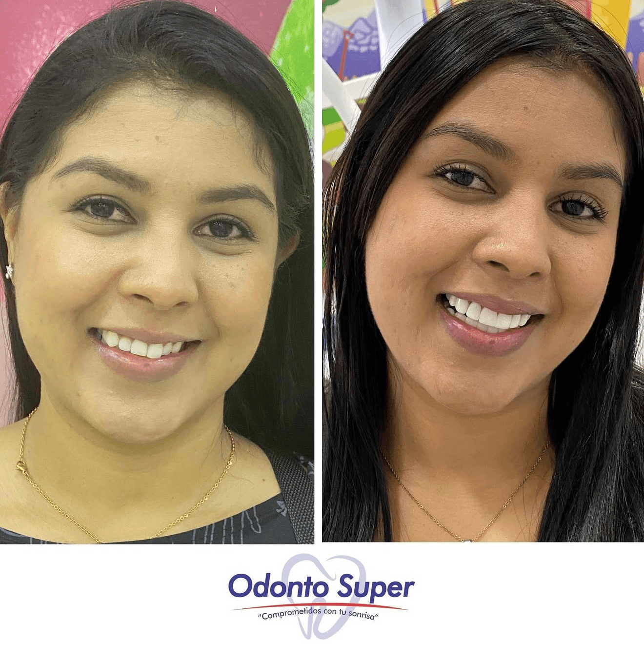 A real Odonto Súper patient smiling before and after her visit