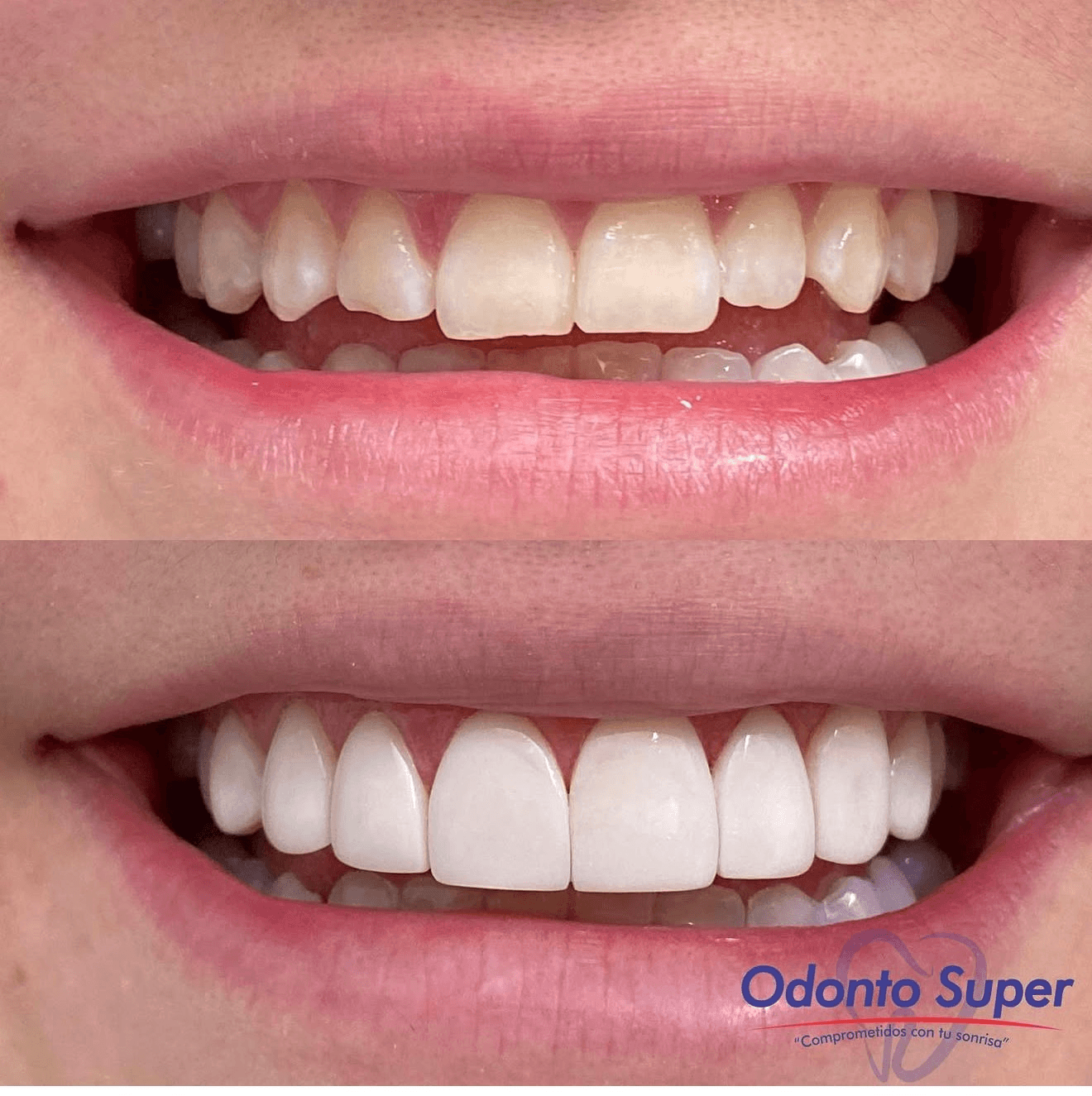 A real patient's smile before and after, full and natural-looking