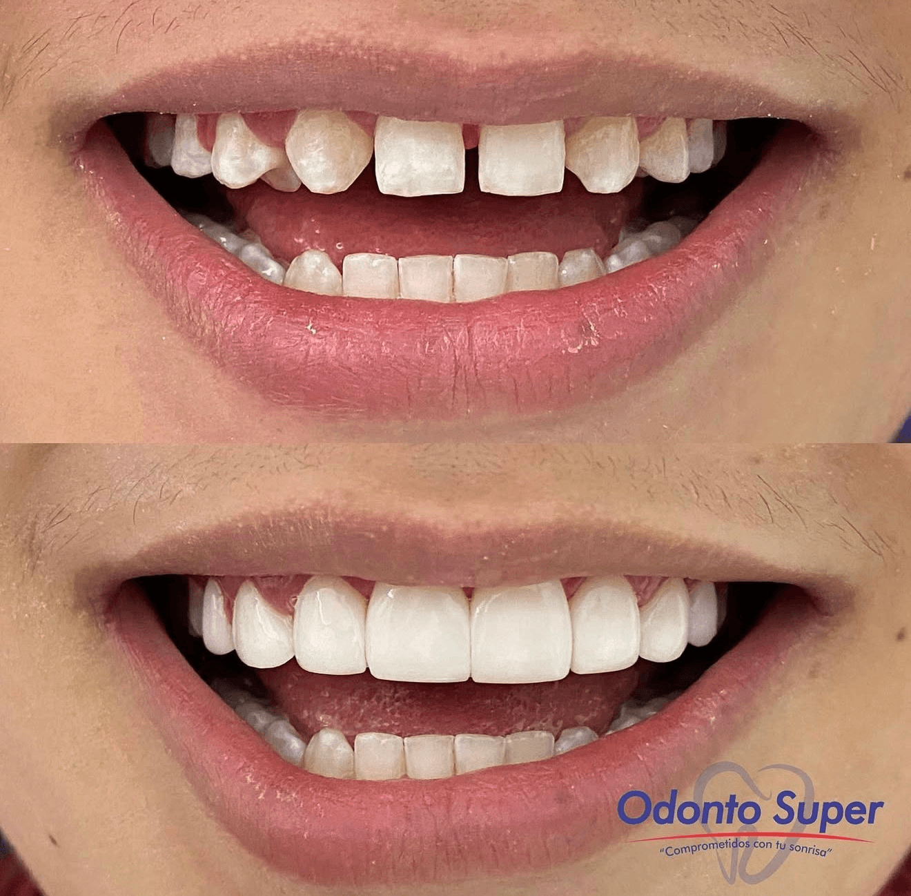 A real patient's smile before and after, straight and confident