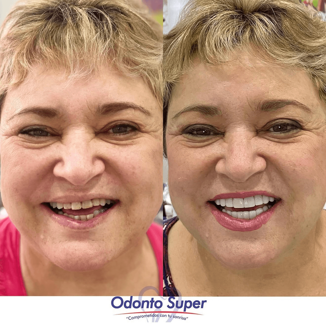 A real patient before and after, with a full, restored smile