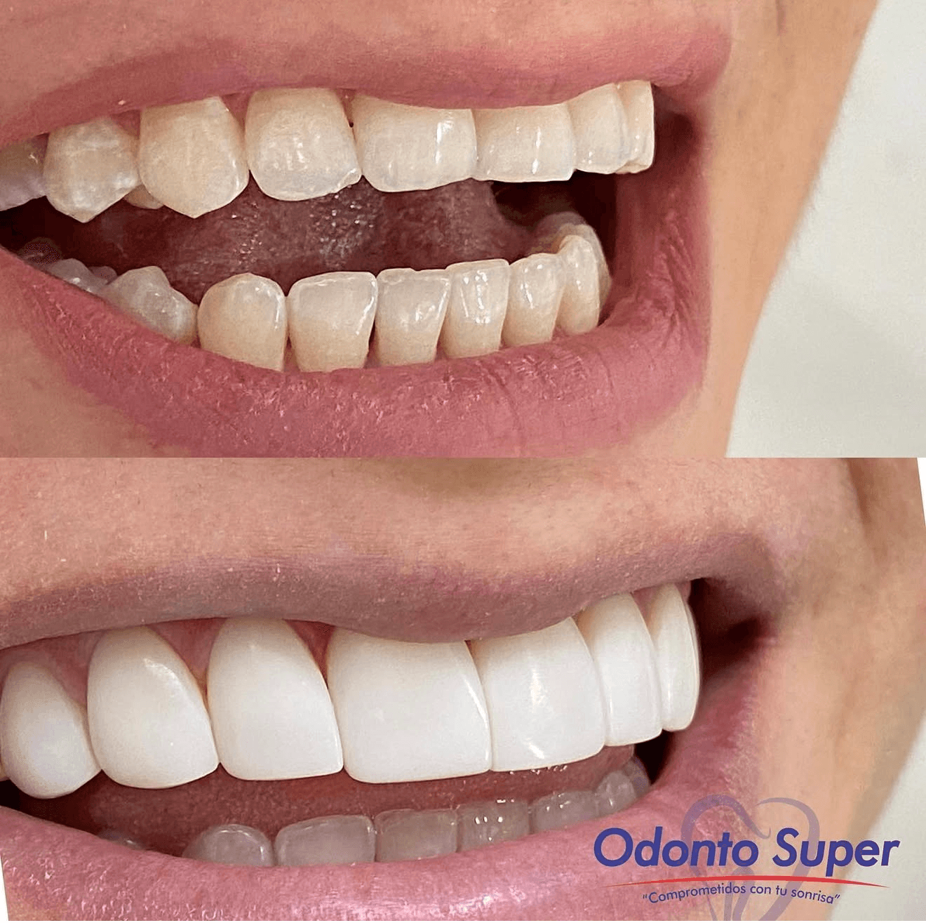 A real patient before and after with a fully restored, healthy, natural smile