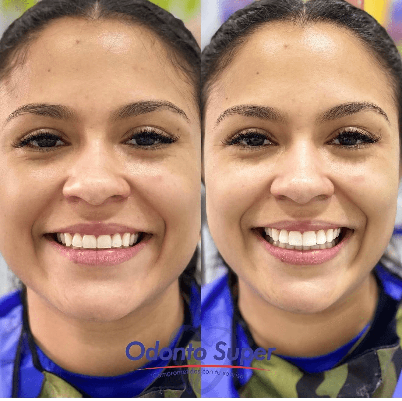 Real Odonto Súper patient smiling before and after treatment in Medellín