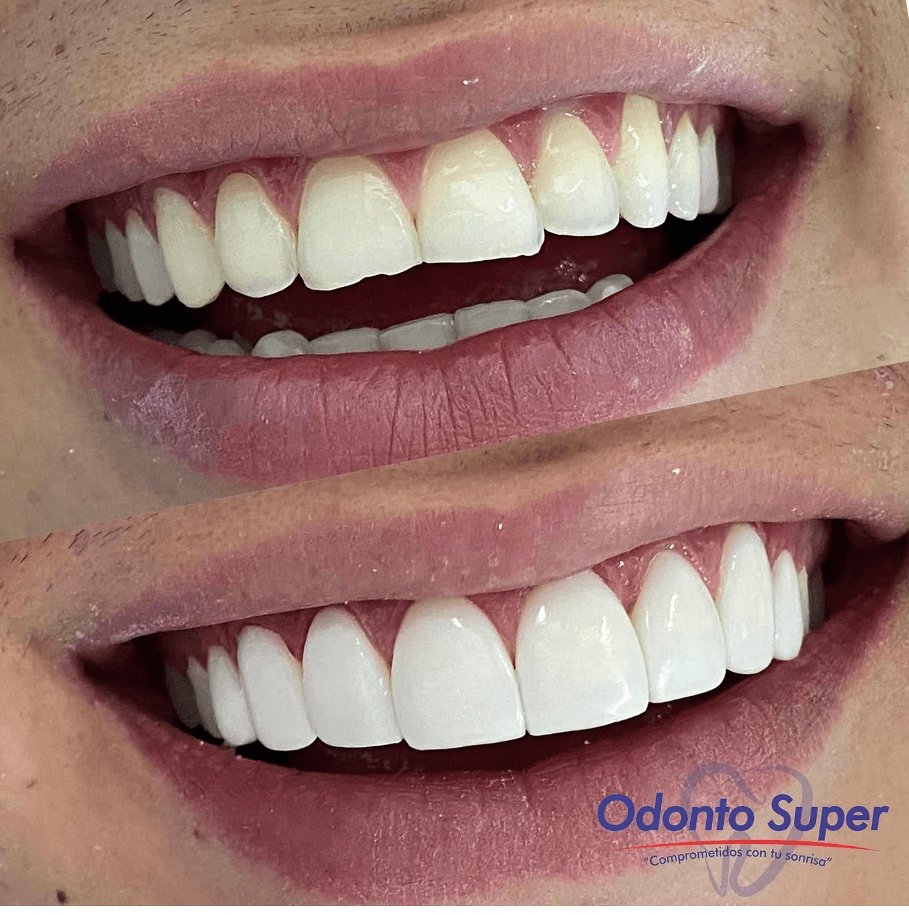 A natural, beautifully designed smile on a real Odonto Súper patient