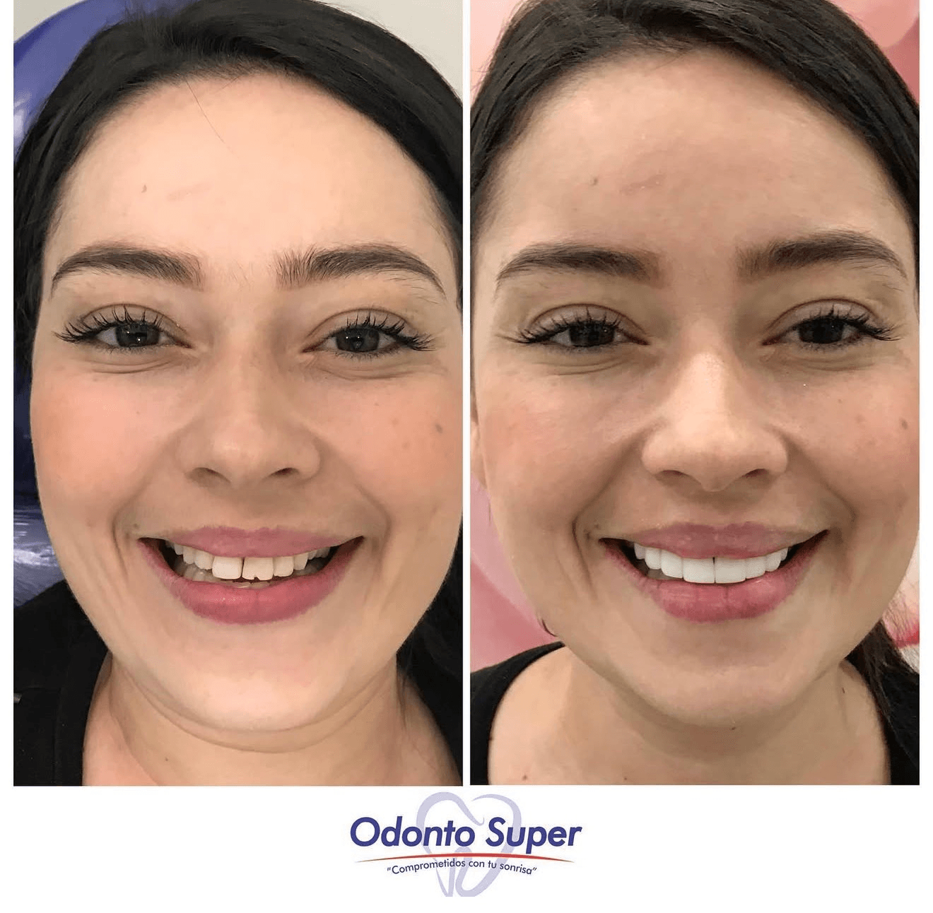 A real patient's smile before and after alignment treatment