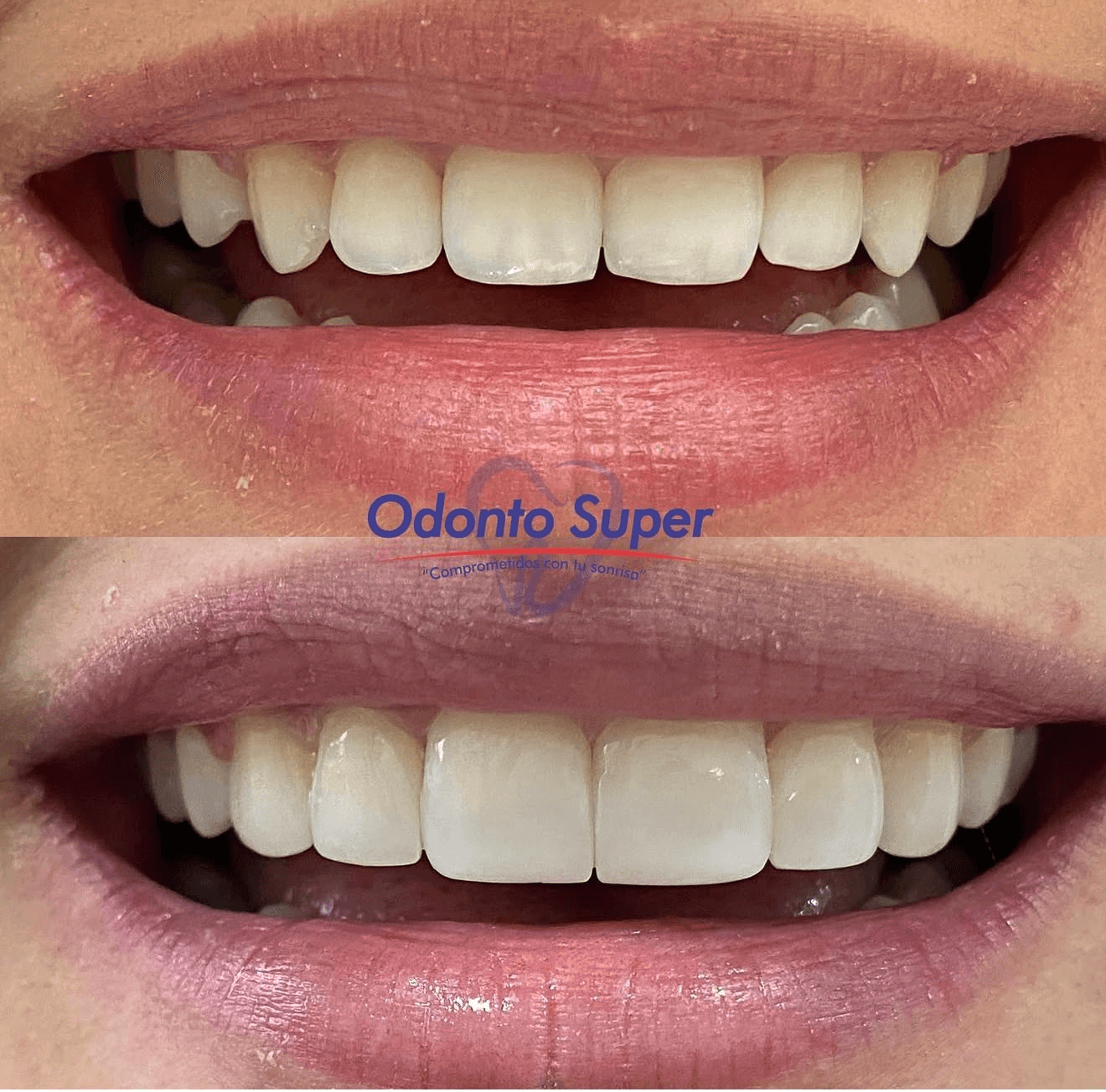 A real patient's smile before and after, showing a radiant, naturally white result